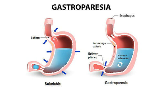 Gastroparesia: una alteración del vaciado gástrico presente en la diabetes
